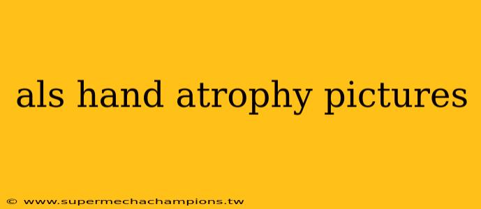 als hand atrophy pictures