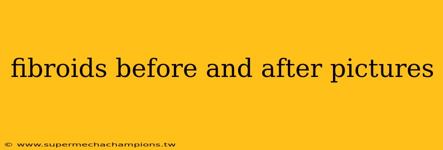 fibroids before and after pictures