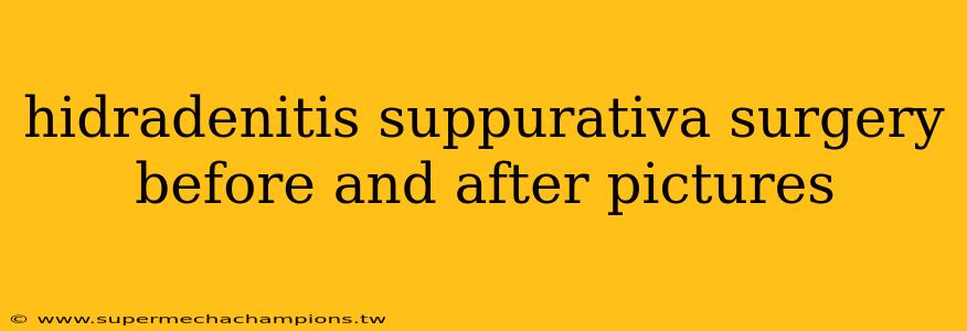 hidradenitis suppurativa surgery before and after pictures
