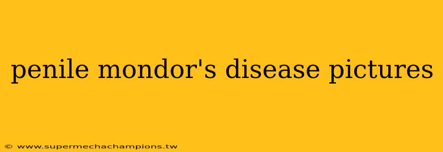 penile mondor's disease pictures