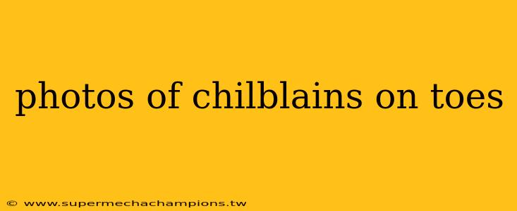 photos of chilblains on toes