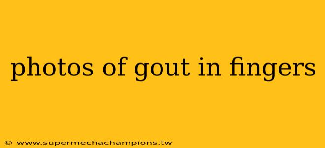 photos of gout in fingers