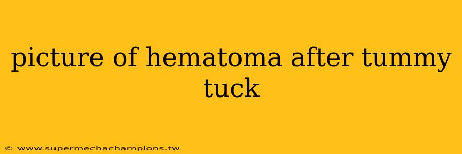 picture of hematoma after tummy tuck
