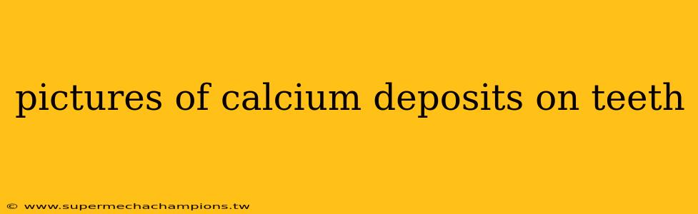 pictures of calcium deposits on teeth