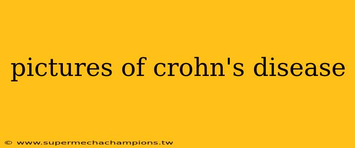 pictures of crohn's disease