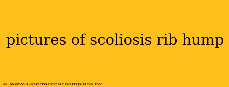 pictures of scoliosis rib hump