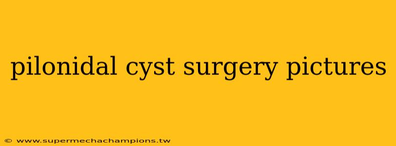 pilonidal cyst surgery pictures