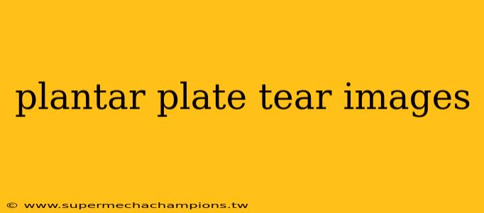 plantar plate tear images