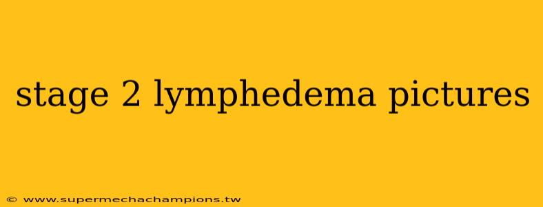 stage 2 lymphedema pictures