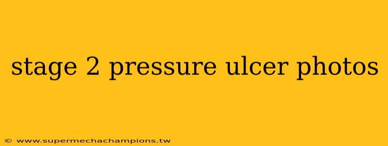 stage 2 pressure ulcer photos