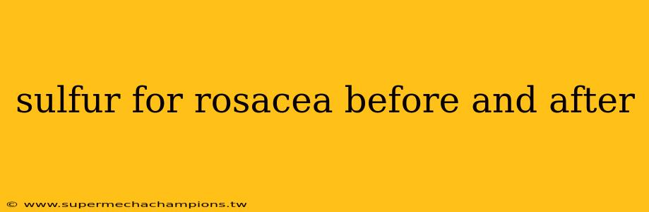 sulfur for rosacea before and after