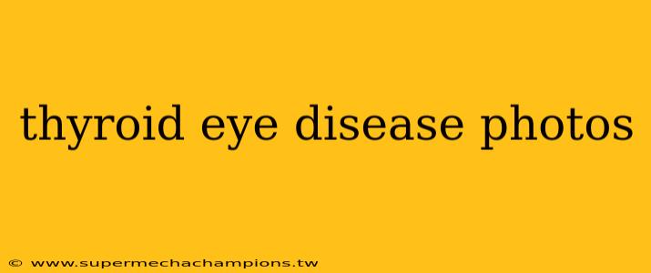 thyroid eye disease photos